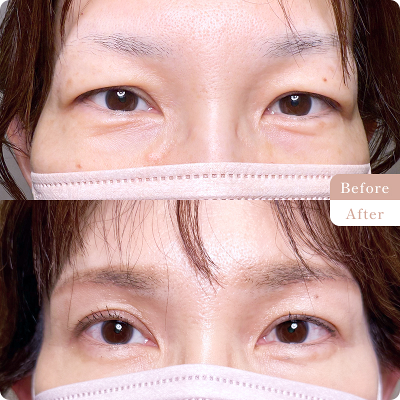 眉下リフト、ボトックス(額、眉間)の施術前後の写真