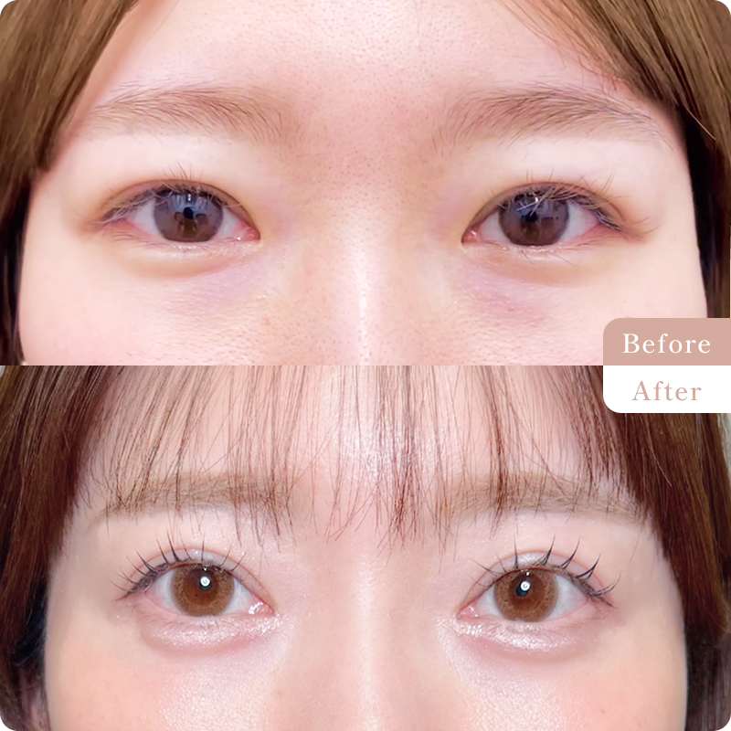 目の下の切らないクマ・たるみ取り、ナノリッチ(目の下)の施術前後の写真