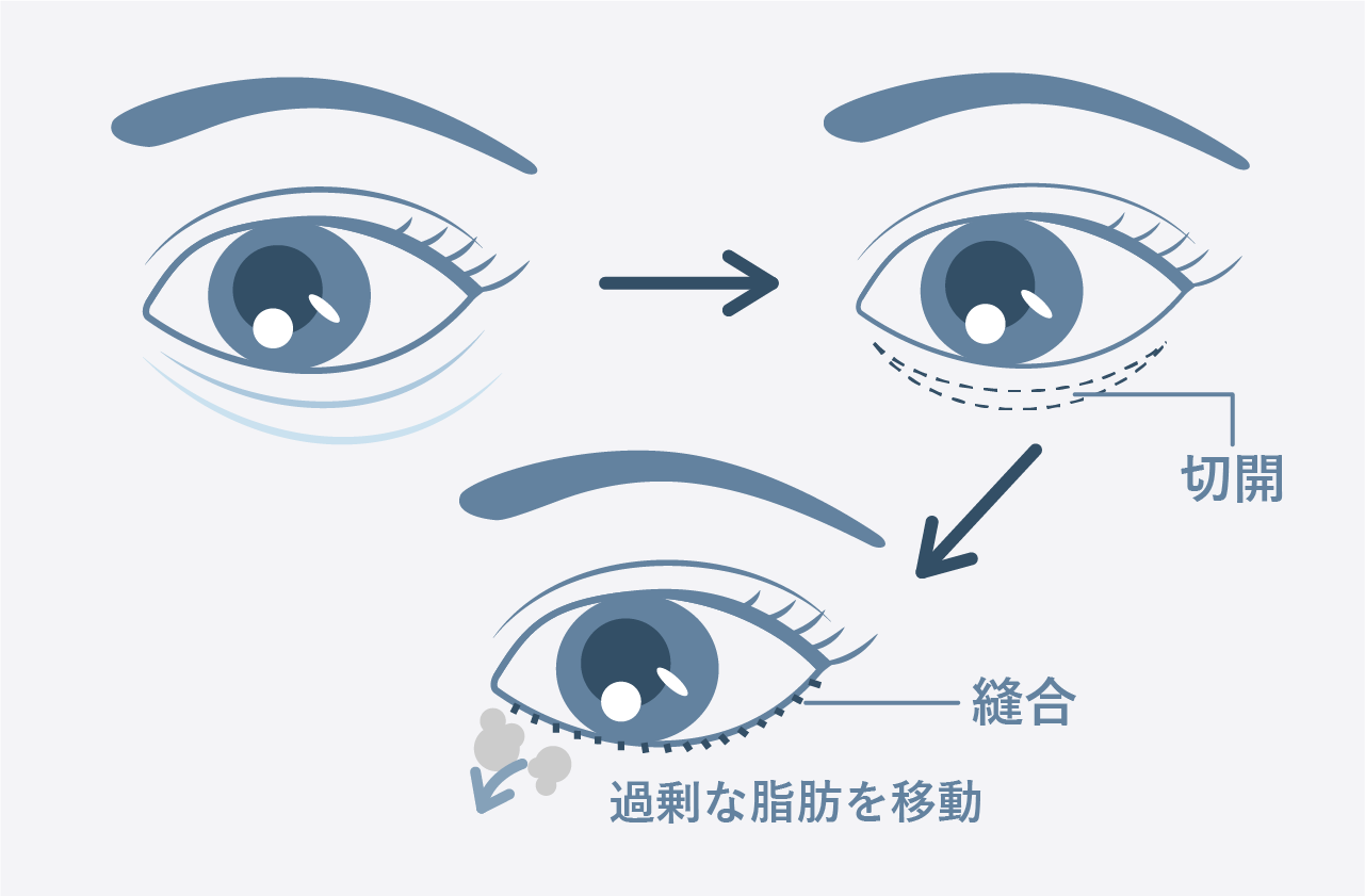 切開ハムラ