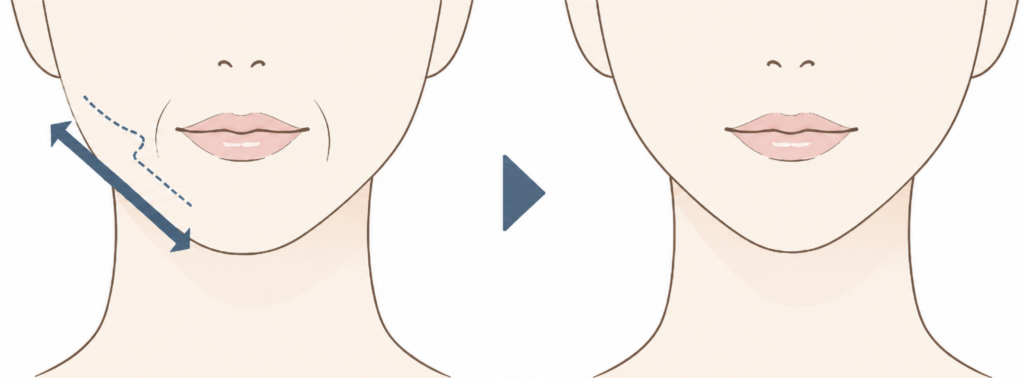 ぽにょりん（エクステンダーマスター）でほうれい線の中心から引き伸ばす